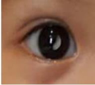 白瞳眼徵